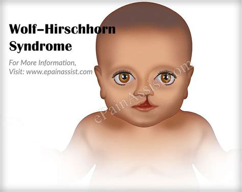 Wolf Hirschhorn Syndrome Wolf Hirschhorn Syndrome Wolf Disorders Genetics