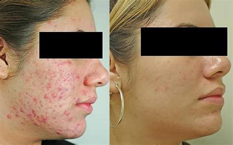 Before And After Photos Of Skin And Acne Treatments The Healthy