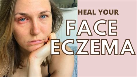 Facial Eczema How To Deal With Eczema On The Face Natural Tips Healing Eczema Naturally