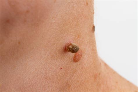 Your Ultimate Guide To Common Benign Skin Lesions Skinfluencer