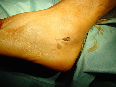 Treatment Of A Unicameral Bone Cyst Of Calcaneus With Endoscopic