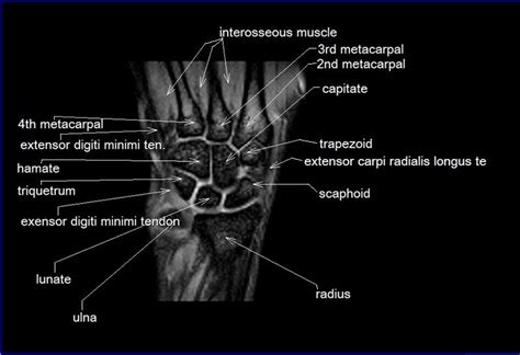 Mri Wrist Coronal Anatomy Wrist Tendon And Ligaments Anatomy Cross