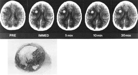 Cerebritis Ct Brain Brain Abscesses Occur Infrequently But Continue To