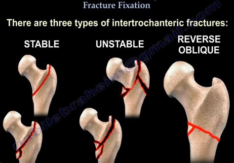 Intertrochanteric Fractures —