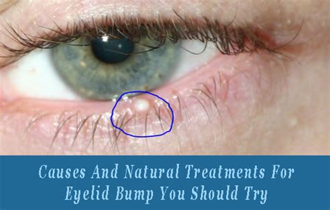 Know The Possible Causes And Treatments Of Having Bump On Eyelid