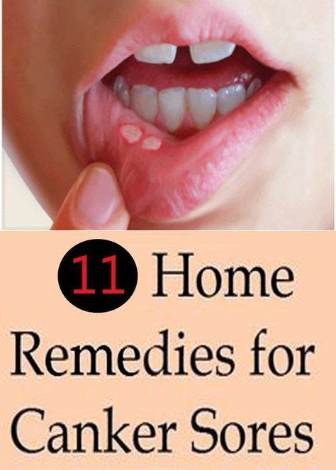 Take A Look At Angular Cheilitis A Condition Where Discomfort Occurs