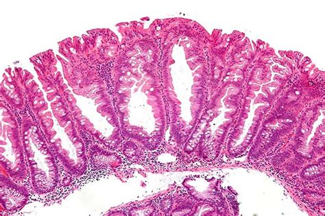Sessile Serrated Polyps And Colon Cancer Prevention Cancerwalls
