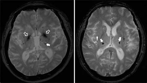 Cerebral Microbleeds On Mri In Patients With Obstructive Sleep Apnea