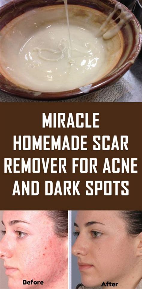 Miracle Homemade Scar Remover For Acne And Dark Spots Scar Removal