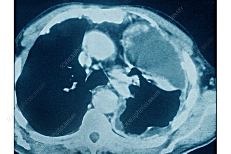 Lung Cancer Caused By Asbestosis Ct Scan Stock Image C0389034