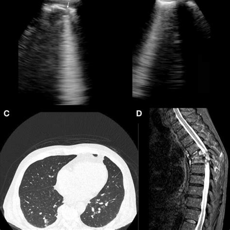 Lung Ultrasound Right Posterior Lung Showing A Subpleural