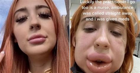 Woman Forced To Call 999 Over Allergic Reaction After Having Lip Fillers Dissolved Daily Star