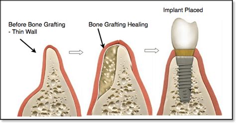 Dental Bone Grafts For Dental Implants