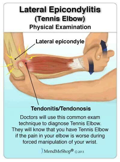 Lateral epicondylitis, commonly known as tennis elbow, is characterized by the inflammation caused by the straining of the tendon called the extensor carpi radialis brevis tendon. 135 best images about Anatomy Visuals on Pinterest ...