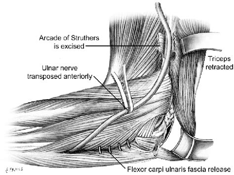 Subcutaneous Ulnar Nerve Transposition