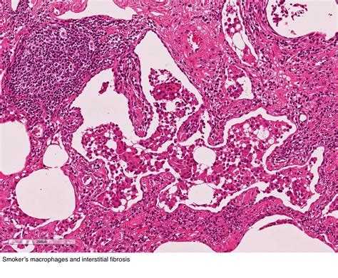 Pathology Outlines Desquamative Interstitial Pneumonitis