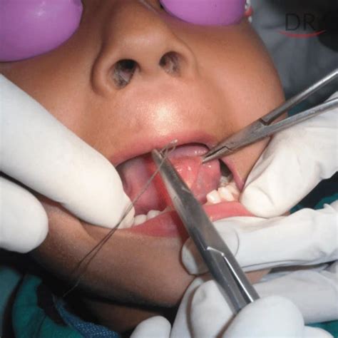 Lingual Frenectomy Using Diode Laser A Case Report
