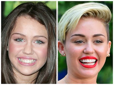 getting porcelain veneers is the perfect way to improve your smile without the… celebrities