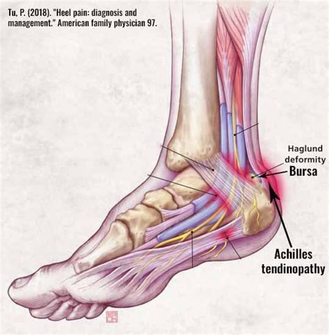 Heel Bursitis Causes And Treatment Treat My Achilles