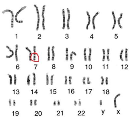 Cystic Fibrosis Chromosome 7 Karyotype Hot Sex Picture