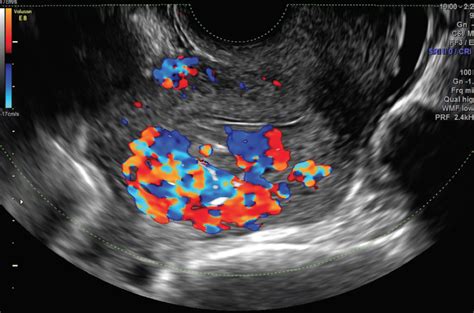 Endovascular Today Diagnosis And Treatment Of Uterine And Pelvic Arteriovenous Malformations