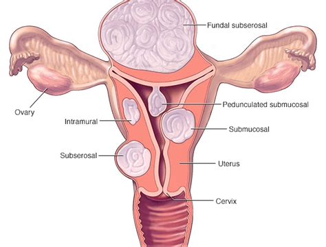 Types Of Uterine Fibroids Best Treatment For Fibroids In Trivandrum