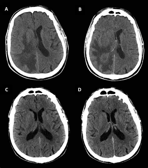 Domestic longhair, himalayan, and persian are the breeds most at risk. Brain tumour mimics and chameleons | Practical Neurology