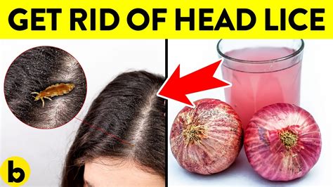 Home Remedies To Get Rid Of Head Lice Youtube