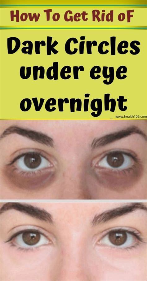 How To Get Rid Of Dark Eyes Circles Under The Eyes Howtoremo