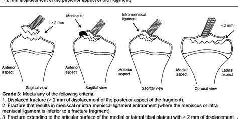 Figure 1 From Arthroscopic Fixation Of Tibial Spine A