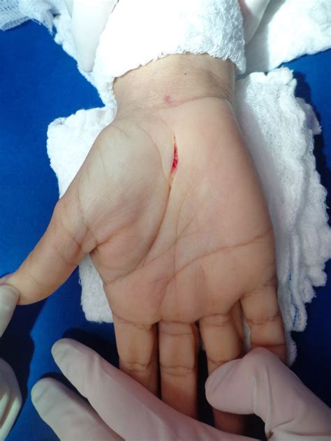 Cicatriz Da Cirurgia Tunel Do Carpo