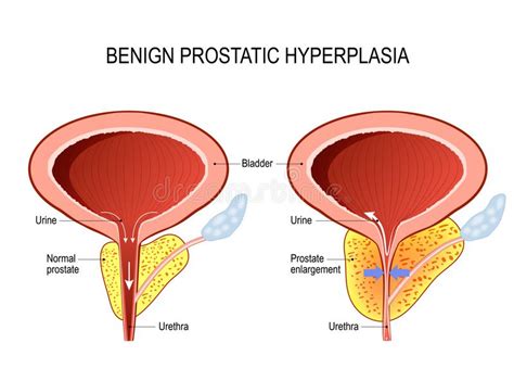 Gutartige Prostatahyperplasie Bph Prostataerweiterung Vektor Abbildung Illustration Von