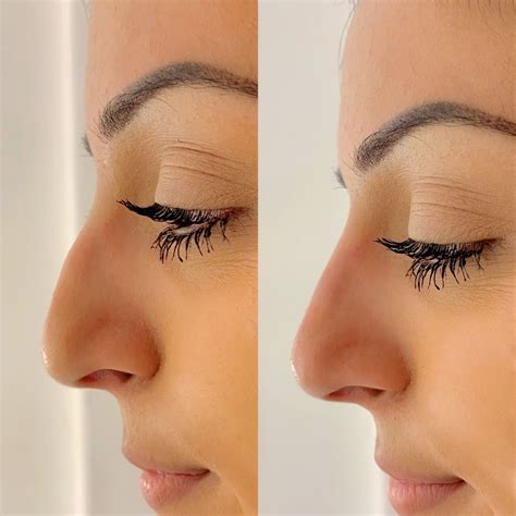 Our Non Surgical Nose Jobs Aka Nose Fillers Can Fill In Lumps And
