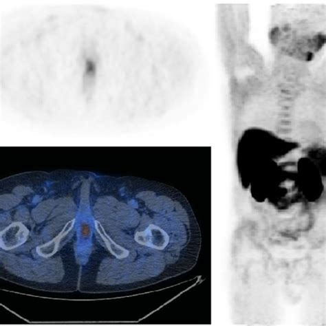 True Positive Case Petct Axial Scan Pet Only Axial Scan Mip This