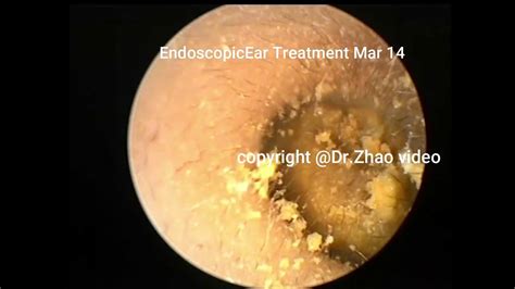 Satisfying Ear Wax Removal Extration With Dr Zhao Video12 Minutes