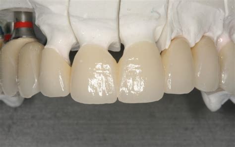 Zirconia Dental