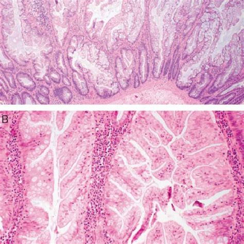 A Sessile Serrated Polyp Adenoma In Case With Basal Crypt