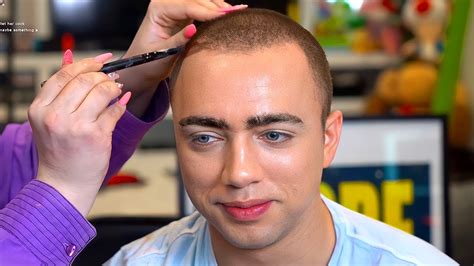 Mizkif Gets Hairline Professionally Fixed Youtube