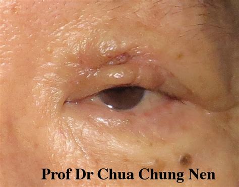 Eyelid Surgery By Prof Dr Cn Chua Excision Of An Upper Eyelid Lesion Followed By Reconstruction