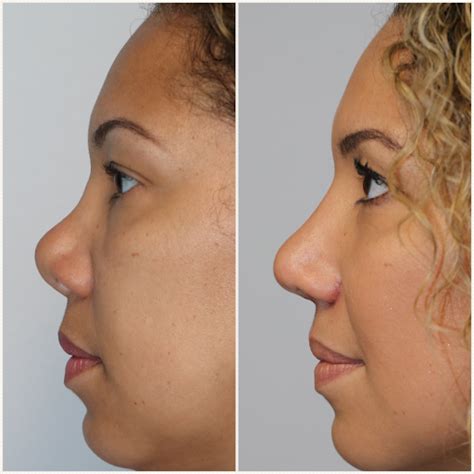 Rhinoplasty For Saddle Nose Westside Face