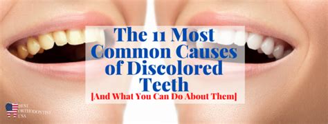 Discolored Teeth The 11 Most Common Causes Of Yellow Teeth