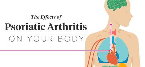 12 Effects Of Psoriatic Arthritis On The Body