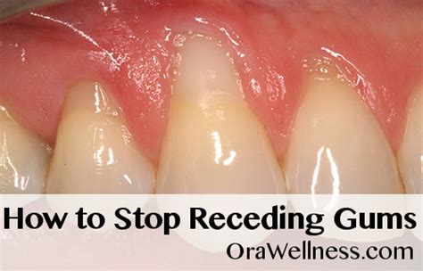 How To Stop Receding Gums Orawellness