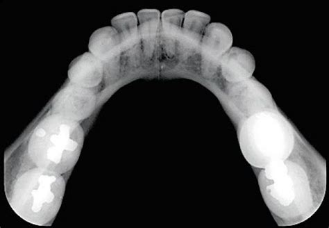 Radiografías Intraorales Dento Metric Radiología Dental Oral Y