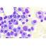 Plasma Cell Myeloma  Hematomorphology A Databank / Imagebank For
