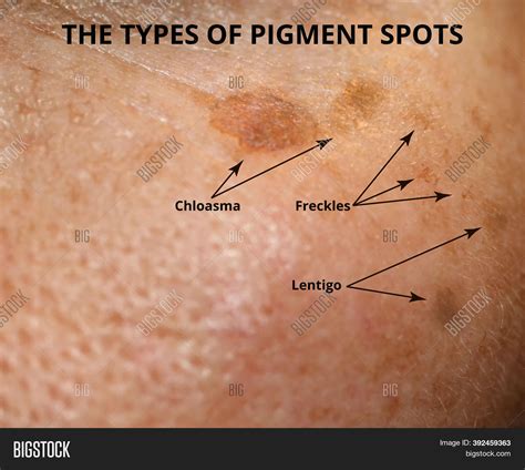 Pigment Spots On Skin