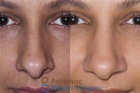 Septorhinoplasty And Turbinate Reduction To Balance The Nasal Profile