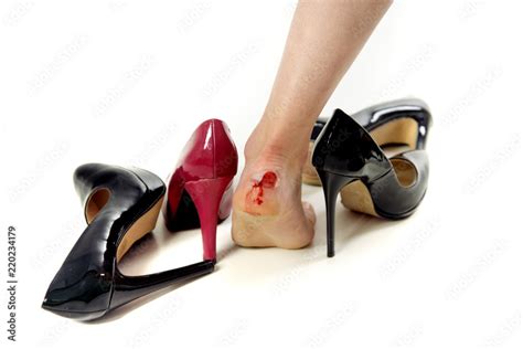 Foot With Bloody Blister On White Background Surrounded With High Heels