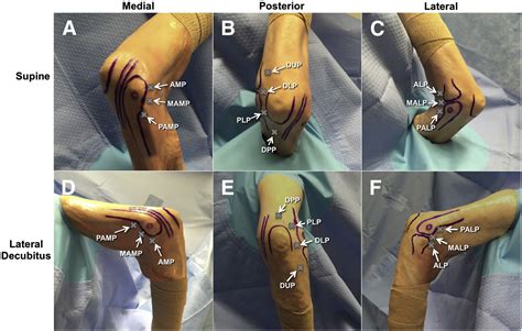 Basics Of Elbow Arthroscopy Part I Surface Anatomy Portals And