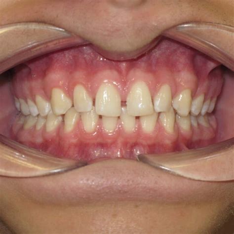Misaligned Teeth Malocclusion Correction Pristine Clear Aligners